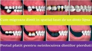 dinte lipsa Clinica dentara Dr. Lintes Iasi Tomesti